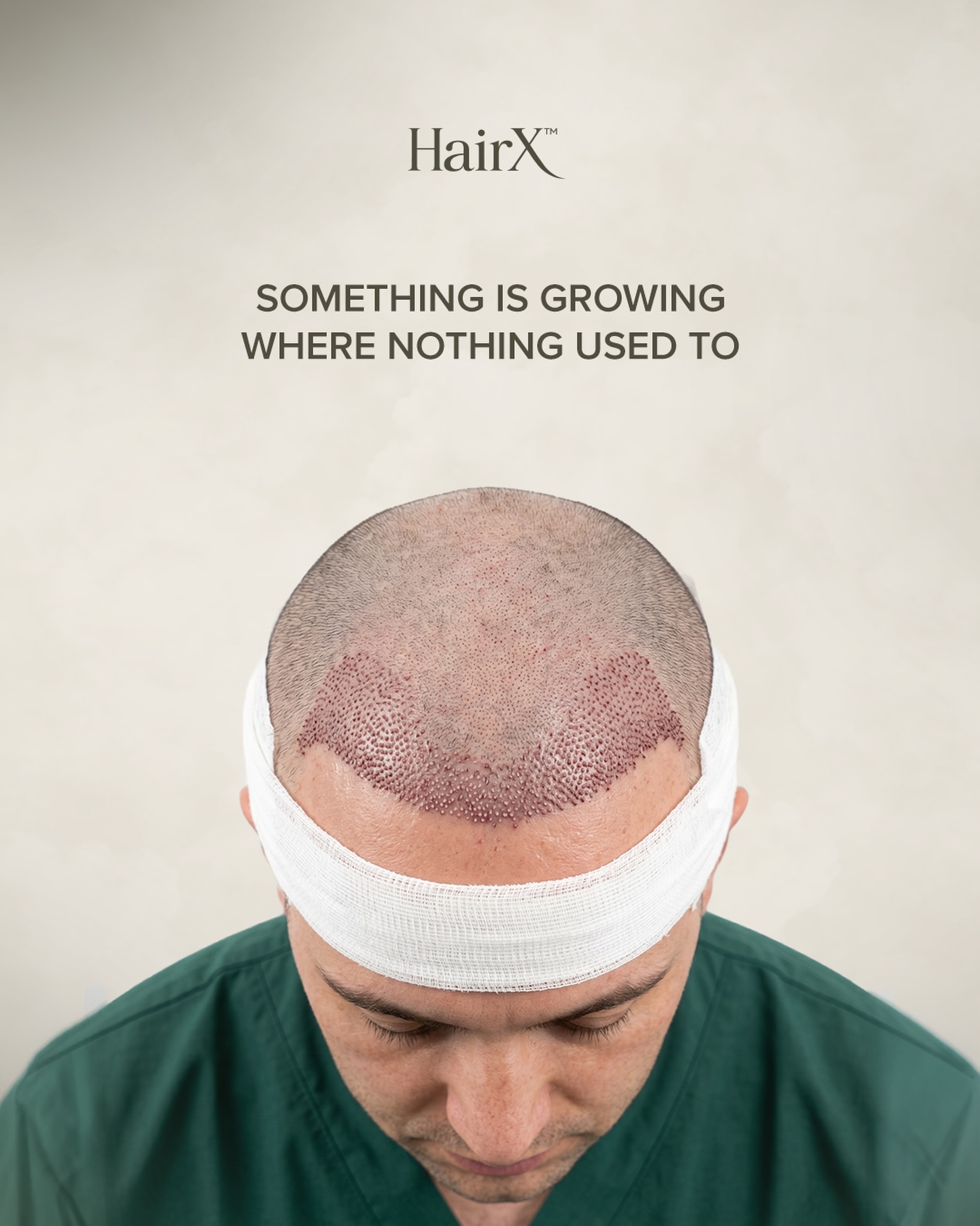 Patient immediately after a hair transplant showing newly implanted grafts and a protective head bandage